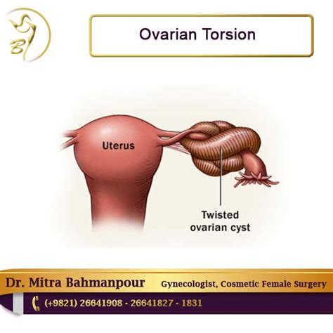 ovarian torsion | ovarian torsion causes | ovarian torsion symptoms ...