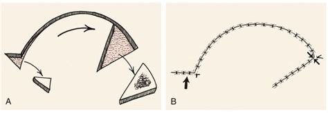 Rotation Flaps | Plastic Surgery Key