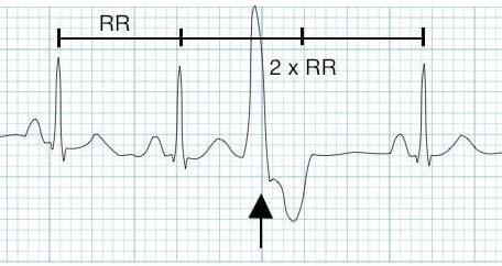 Understanding ECG features of ectopic heartbeats