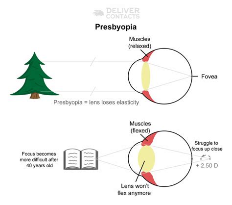 Presbyopia: Definition, Causes, & Symptoms | Deliver Contacts