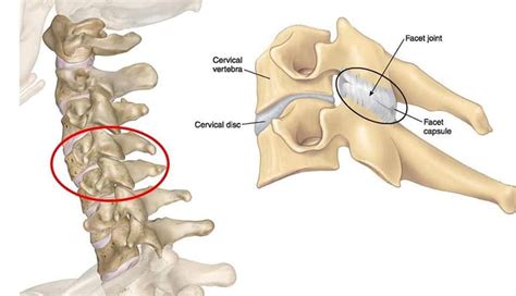 Cervical Facet Joint Pain | Complete Physio