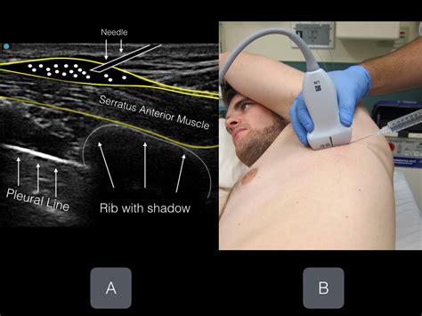 Serratus Anterior Plane (EASY) — Highland EM Ultrasound Fueled pain management