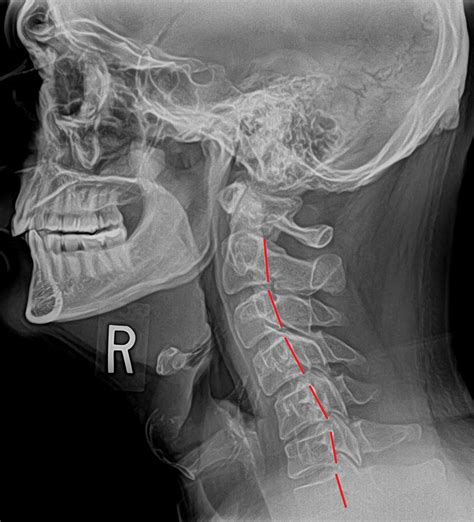 Reversed curve neck x-ray - Cascade Chiropractic & Wellness