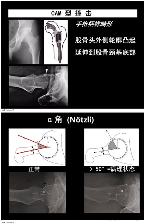 髋关节镜