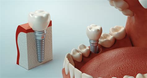 ¿Qué causas provocan el rechazo de un implante dental? - Clínica Dental ...