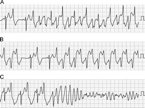 Polymorphic Ventricular Tachycardia