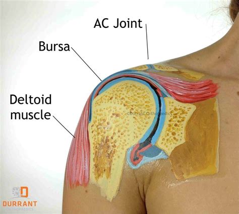 Shoulder Bursitis & Rotator Cuff Tears - Part Three