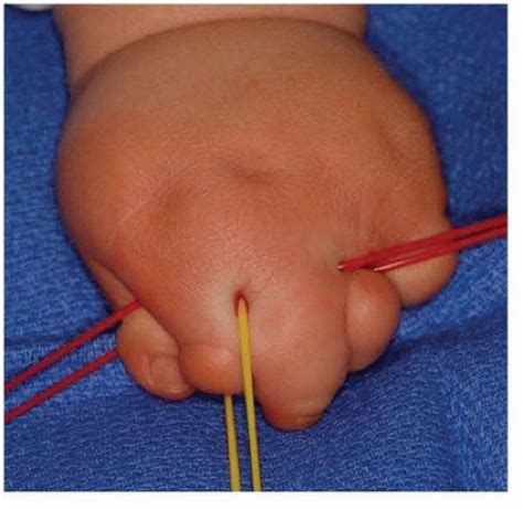 Amniotic Band Syndrome | Musculoskeletal Key