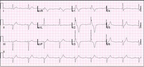 Dr. Smith's ECG Blog: Emergency Transvenous Cardiac Pacing