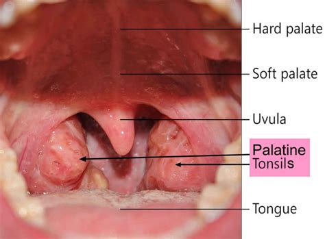 Tonsil stones causes, symptoms, diagnosis and tonsil stones treatment