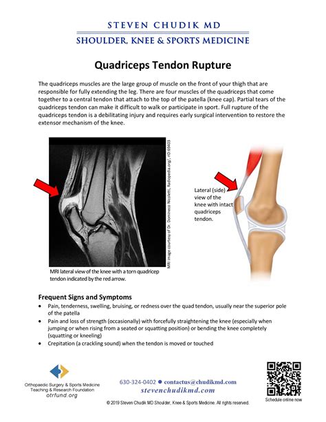 Ruptured Quadder: My Experience With Bilateral Quadriceps