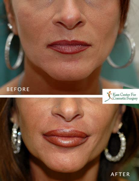 Lip Plastic Surgery - Before & Afters - Kass Center for Cosmetic Surgery