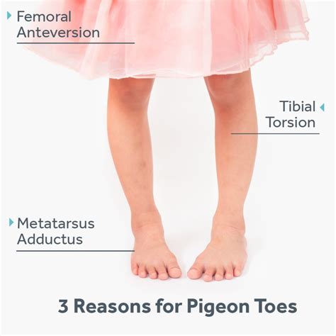 Pigeon Toes – What, Why & When Kids Need Treatment | Surestep