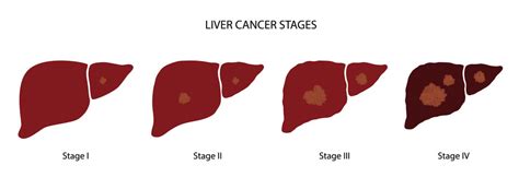 Stages of Liver Cancer & Financial Assistance for it | Impactguru