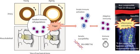 A shared basis for overlapping immunopathologies in giant cell arteritis and polymyalgia ...