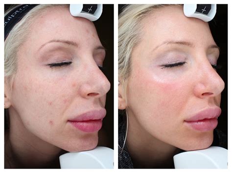 Before and After: my Halo Laser Treatment Results! — Med-E-Spa