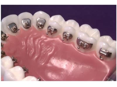 Orthodontic Brackets | Dentalcompare.com