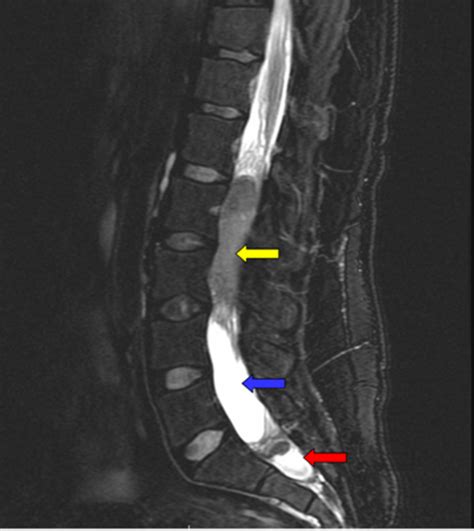 Figure 2 from Intradural extramedullary Ewing tumor of the lumbar spine | Semantic Scholar