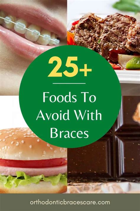 Foods To Avoid With Braces [With Lists & Alternatives] - Orthodontic ...