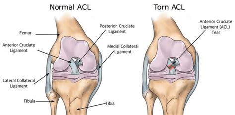 Types Of Surgical Procedures To Repair ACL Tear