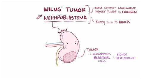 Video: Nephroblastoma (Wilms tumor)