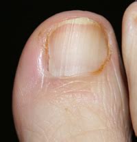 Nail Surgery Healing following Partial Nail Avulsion