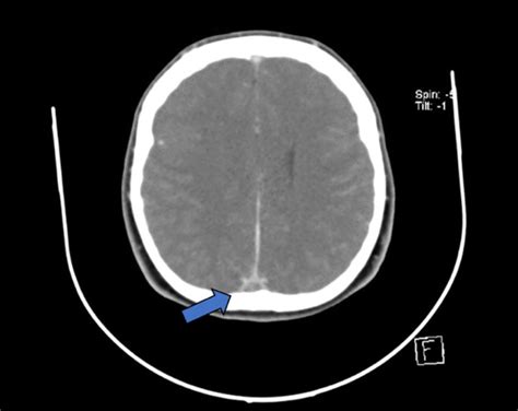 CT venography showing the empty delta sign (arrow) | Download ...