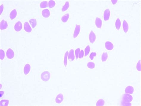 Sickle Cell Anemia