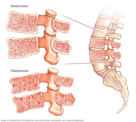 How To Check For Bone Density - Ademploy19