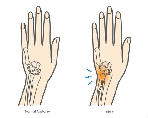 What is an Extensor Carpi Ulnaris (ECU) Subsheath Rupture? - Upswing Health