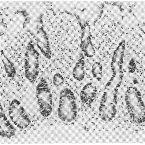 (Case 5.) Small intestinal biopsy showing severe villous atrophy with... | Download Scientific ...