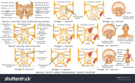 Paranasal Sinus: Over 141 Royalty-Free Licensable Stock Vectors & Vector Art | Shutterstock