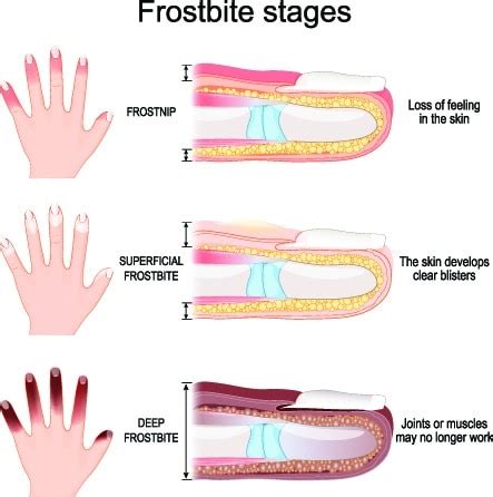 Frostbite cases could increase with cold temps coming this week ...