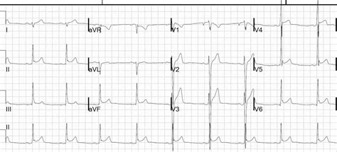 Repolarization Ecg