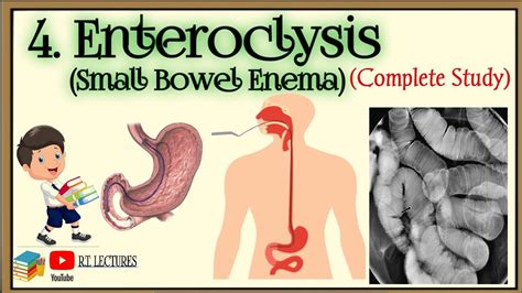 #Enteroclysis complete procedure #Small Bowel Enema procedure #Enteroclysis Complete lecture ...