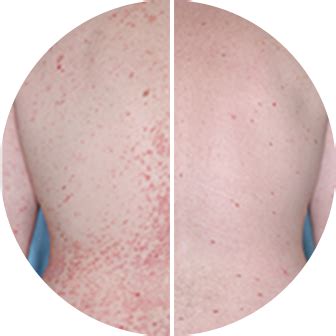 See the Benefits of Otezla® (apremilast) - Plaque Psoriasis Medication