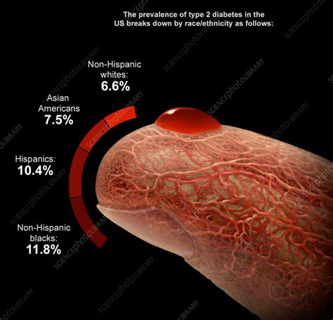 Type 2 Diabetes by Race and Ethnicity - Stock Image - C043/6335 ...