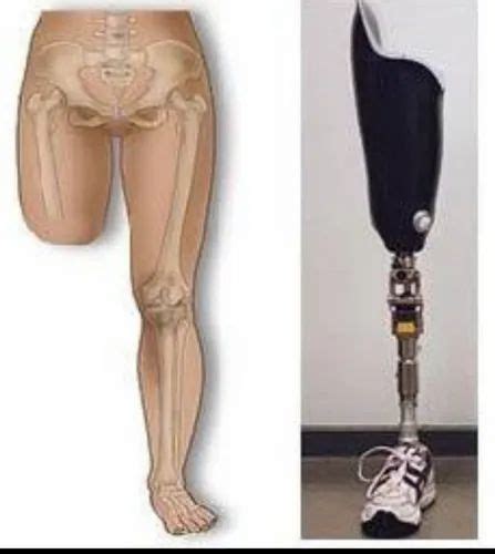 Above Knee Prosthesis at Rs 40000 | New Items in Secunderabad | ID ...