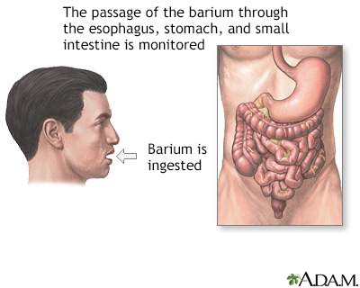 Upper Gi Series Ulcer