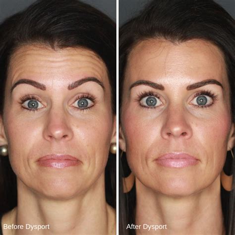 Botox Before and After | Botox, Cosmetic injectables, Botox fillers