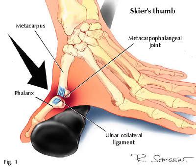 Skier's Thumb | Finger Injuries | Colorado Hand Specialist