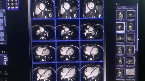 MRI Cardiac For Child With Transposition of the Great Arteries (TGA) Surgery After birth(Follow ...