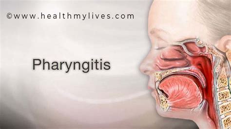 PHARYNGITIS-CAUSES, SYMPTOMS AND PREVENTION