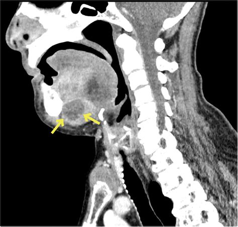 Ludwigs Angina Radiology