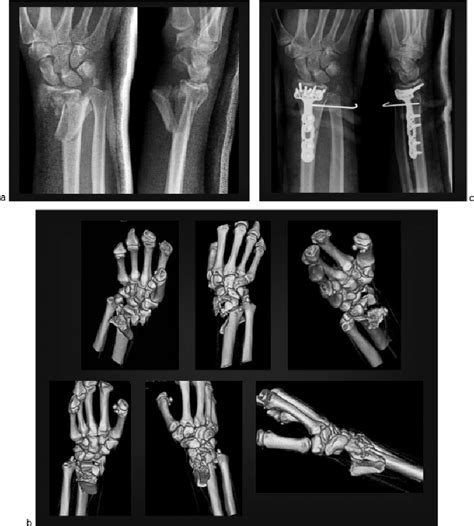 ( a ) X-ray images showing a high-energy intra-articular fracture of... | Download Scientific ...