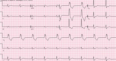 加速性心室自主節律 Accelerated idioventricular rhythm