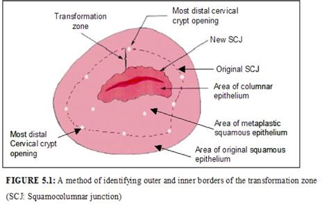 Colposcopy - Dr. Nitu Bajekal