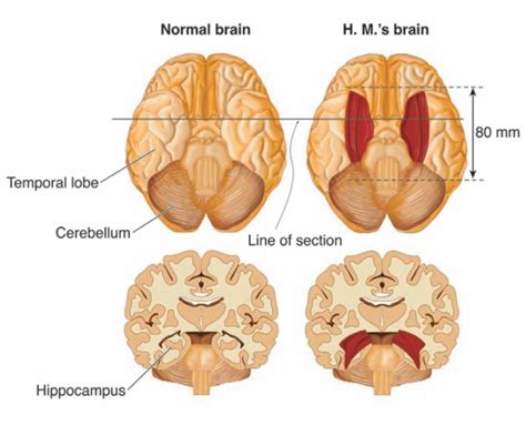 Patient H.M. Case Study In Psychology: Henry Gustav Molaison