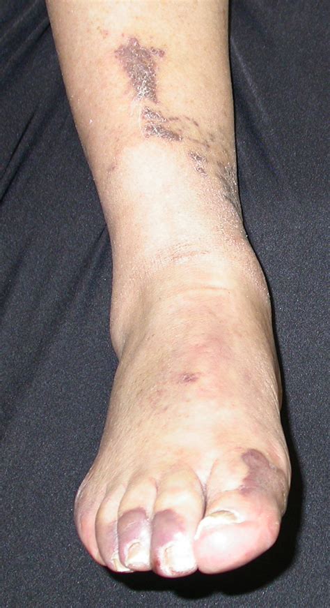 Kaposi's Sarcoma (KS) - Dermatology Advisor