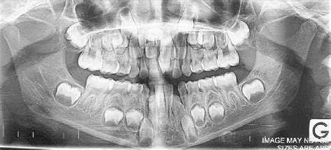 Panoramic radiograph shows the impacted permanent upper central... | Download Scientific Diagram